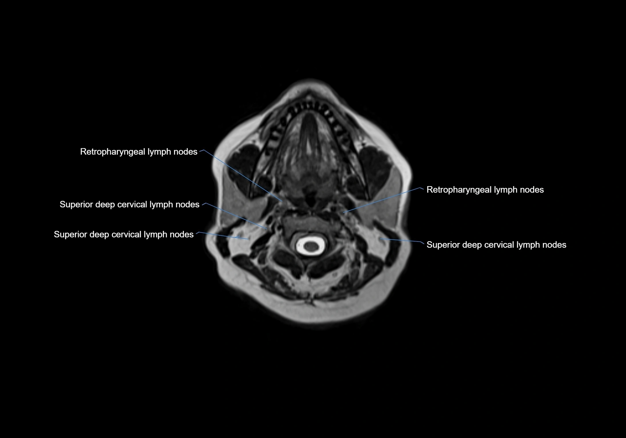 Neck axial  lymph node cross sectional MRI anatomy 3T MRI  image-img-00001-00041.webp